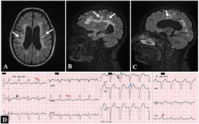 Non-Compaction Cardiomyopathy and Multiple Sclerosis: Associated or Independent Diseases? A Case Report